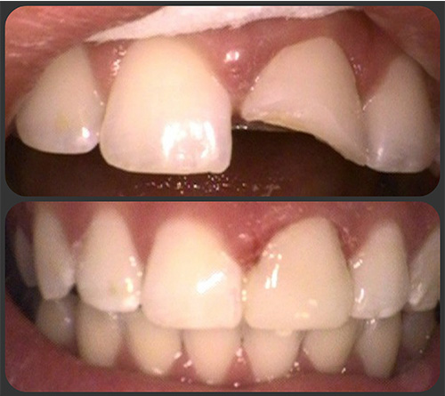 chipped tooth - before and after 