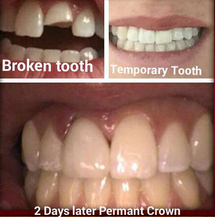 Broken tooth - before and after